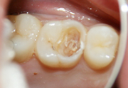 潜伏虫歯　術中