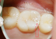 潜伏虫歯　術前