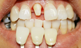 オールセラミック 術中