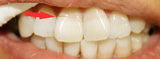 オールセラミック 術前