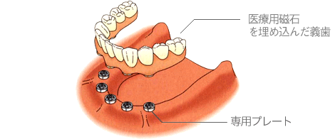 マグネット義歯