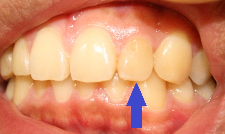 激しい痛みを伴います